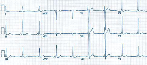 QRS as a demonstration of the fusion of two depolarization lines one normal and one abnormal arriving to the ventricles via abnormal conductive pathway.