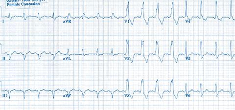 ECG manifestation of hemiblocks frequently combines with the RBBB. Combination of RBBB with anterior hemi block is one of the most common types of the disturbances of ventricular conduction.