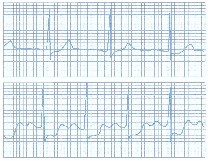 nitroglycerine. The ECG during the rest has no marks of ischemia, because there is no ischemia in fact. The ECG changes can be provoked by exercise ECG.