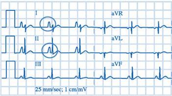 and symmetric in the leads II, III, avf and in precordial leads V 1-2, which are the closest recording electrodes. Sometimes the chest leads V 1-2 record biphasic P wave.