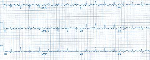 hypertrophy of right ventricle produces positive R deflections with high amplitude.