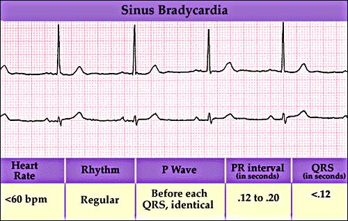 Sinus Bradycardia HR< 60 bpm; every QRS narrow, preceded by p wave Can be normal in