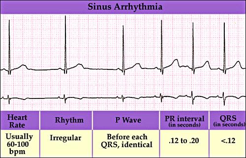 Sinus Arrhythmia Variations in the cycle lengths between p waves/ QRS complexes