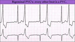 Coupling of VES Premature ventricular beats occurring after every normal beat