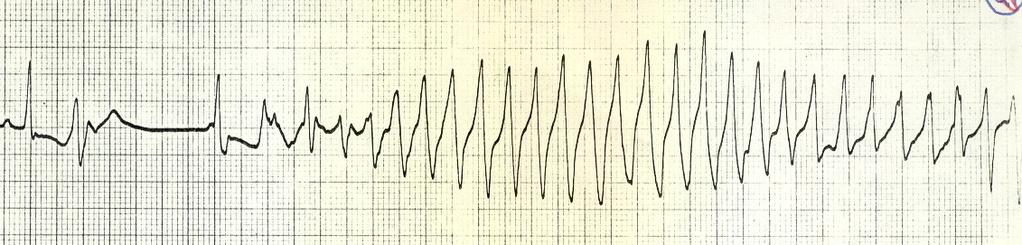 Polymorphic ventricular tachycardia torsades de pointes Is connected with prolonged QT