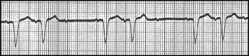 2 nd Degree AV Block Type 1 (Wenckebach) EKG Characteristics: Progressive prolongation of the PR interval until a P wave is not conducted.