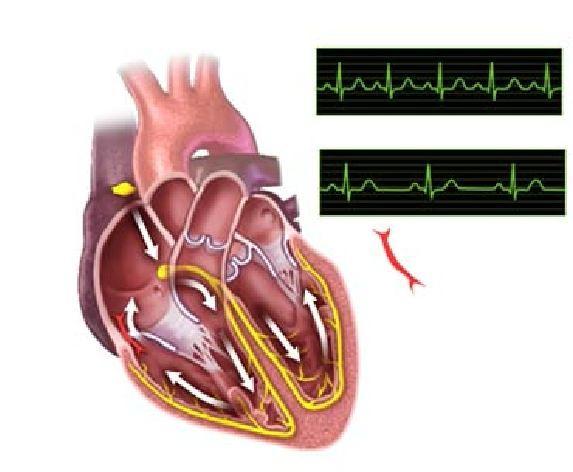 Wolff-Parkinson White Syndrome (WPW) is a condition in which the heart beats too fast