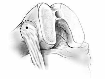 Referencing the Posterior Condyles The posterior condyles can be used for a knee that is in varus or neutral alignment without posterior condyle bone loss.