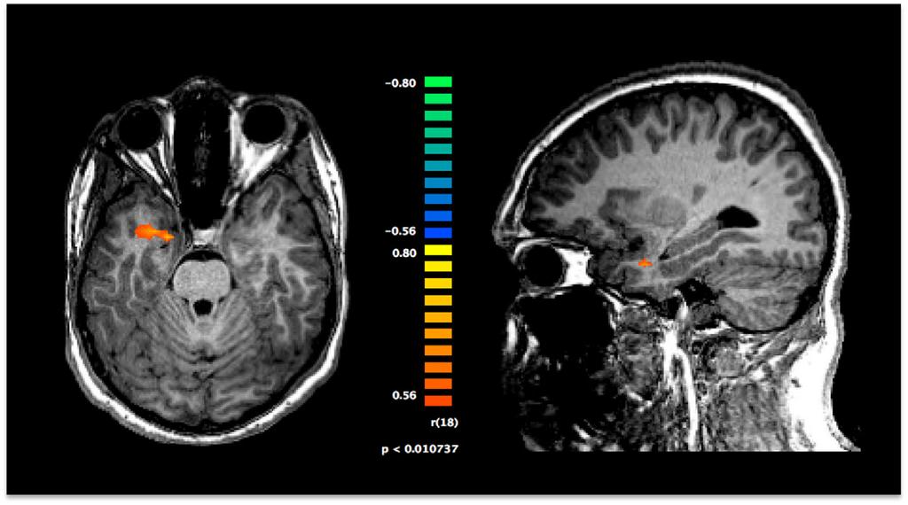 K.S. Scherf et al. / NeuroImage: Clinical 7 (2015) 53 67 63 RH LH RH Anterior Temporal Pole (31, -3, -23) 4 4 Faces - Other (Beta Weights) 2 0-2 Faces - Other (Beta Weights) 2 0-2 -4 0.