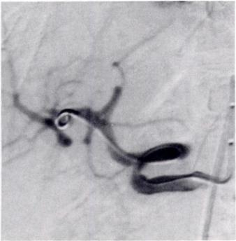 Once formed, the catheter can be used selectively to catheterize the common hepatic artery, thus allowing delivery of the balloon catheter coaxially at the site of stenosis (Fig. 1).