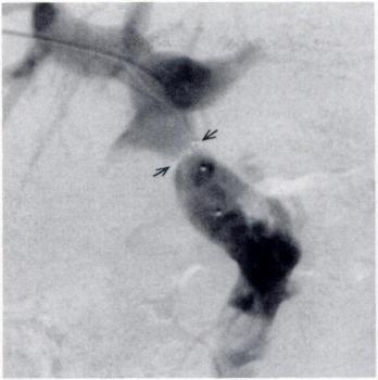 C, Two balloons inflated across stenosis. Pressure gradient measured when catheter was withdrawn across stenosis confirmed reduction of gradient.