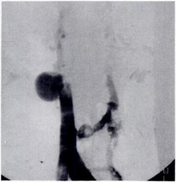 170 RABY ET AL. AJR:157, July 1991 A -C a Lt cluded, a liver biopsy is performed and if the diagnosis is not clear cut, assessment of graft vascularization is indicated.