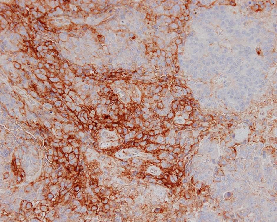 PD-L1 Immunohistochemistry: Expression Heterogeneity and Potential