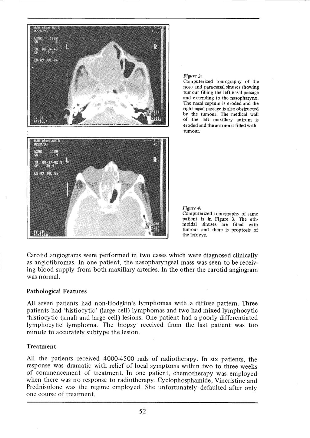 Figure 3: Computerized tomography of the nose and para-nasal sinuses showing tum our filling the left nasal passage and extending to the nasopharynx.
