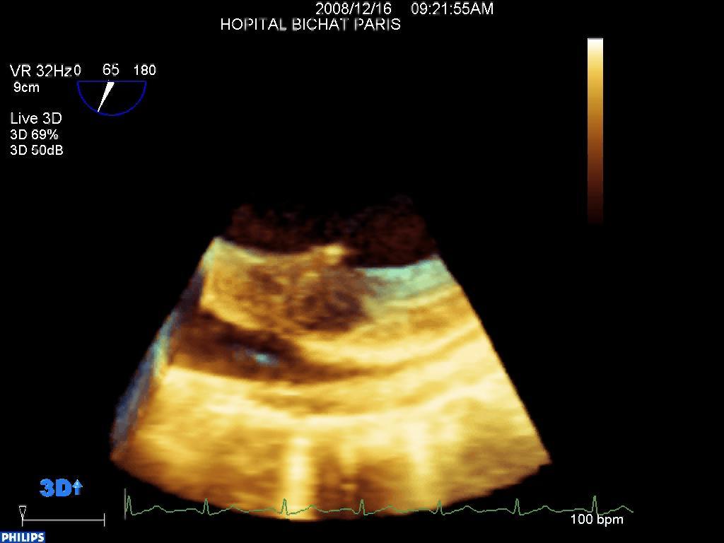 Echo guided transseptal