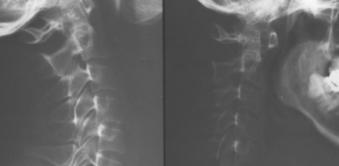 Perioperative Evaluation and Inpatient Management of Immunosuppression in Rheumatic Diseases A 48-year-old man with a 20-year history of seropositive, nodular, erosive RA presents for elective total