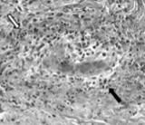 Cutaneous Vasculopathy in Users of Levamisole-Adulterated Cocaine Levamisole: Immunomodulatory properties: used to treat RA in the 1970s and colon ca with 5-FU in the 1990s Removed from the US market