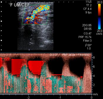 Figure 1 Doppler ultrasound 1 Pre-anastomosis