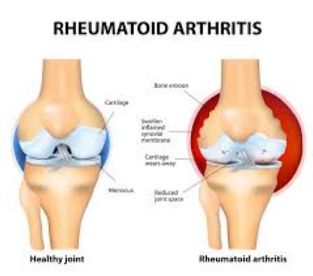 Rheumatoid Arthritis Inflammation of one or more joints Symptoms: