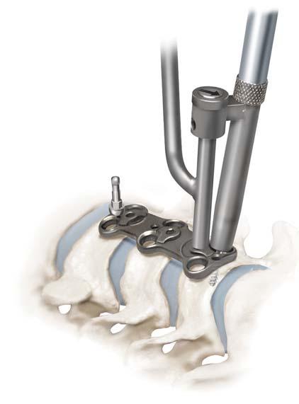 Once contact is made, rotate the Tap counterclockwise until it is free of the bone and remove it from the Guide Tube.