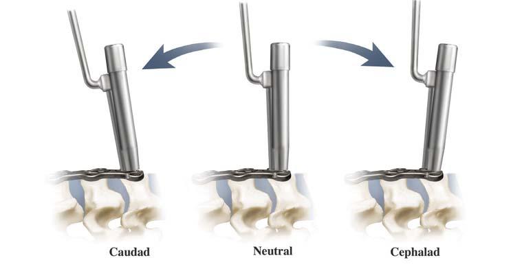 24 Trinica and Trinica Select Surgical Technique Reposition the Guide Tube until the desired screw placement