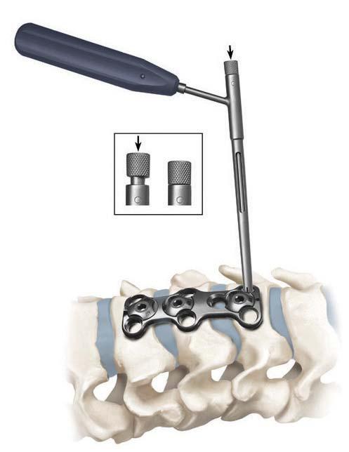 Trinica and Trinica Select Surgical Technique 3 Plate Selection Overview: Select the appropriately-sized plate for fixation to the vertebral bodies.