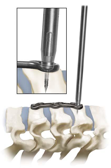 4 Trinica and Trinica Select Surgical Technique Plate Bending (Optional) ANVIL ANVIL Overview: All Plates in the Trinica and Trinica Select Anterior Cervical Plate System are prelordosed to match the