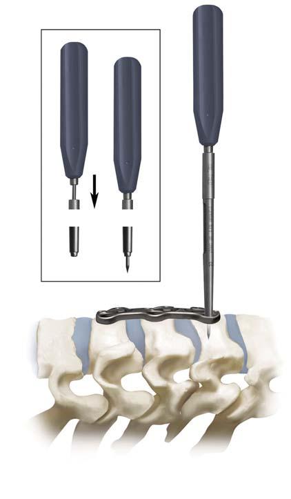 8 Trinica and Trinica Select Surgical Technique (Alternative): Fixed Screw Placement (Awl) Overview: As an alternative to the use of the Fixed Angle Drill Guide, Drill and Tap, a Fixed Angle Awl is