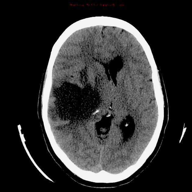15. A small infarct in a 65 year-old woman destroyed the ventral posterior thalamic nucleus on the right side. Which of the following would describe all of her deficits: A.
