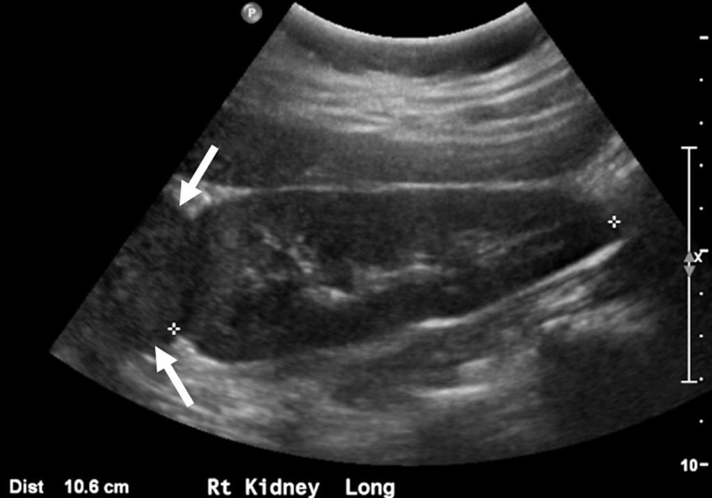 Gray-Scale US What to look for Morphologically abnormal kidneys Focal scarring Dysplasia/hypoplasia