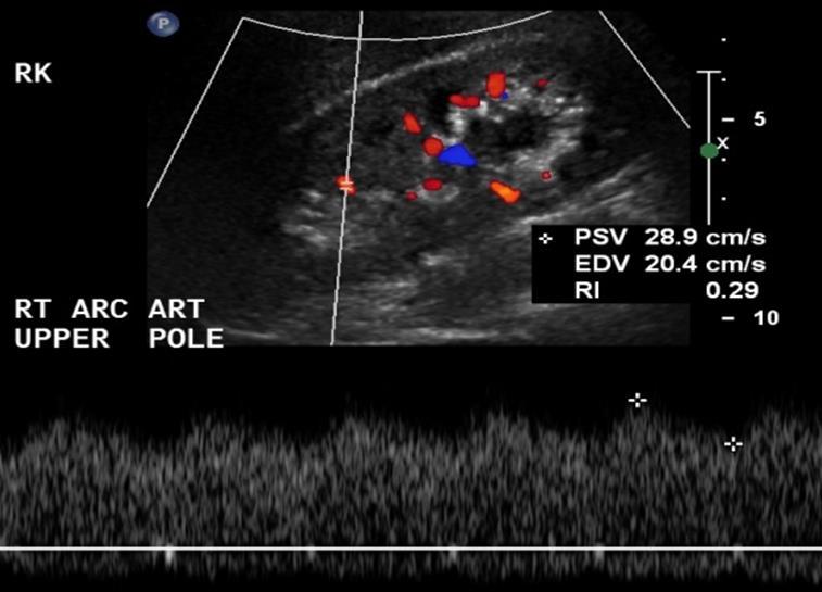 Renal Doppler US Technique Renal Doppler US exam Standard gray-scale imaging Color Doppler Main renal artery