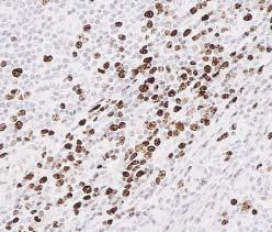 B, Same focus stained for proliferating cell nuclear antigen with anti Ki-67 showing proliferating cells (anti Ki-67 immunoperoxidase counterstained with hematoxylin,  The origin of the TdT-positive