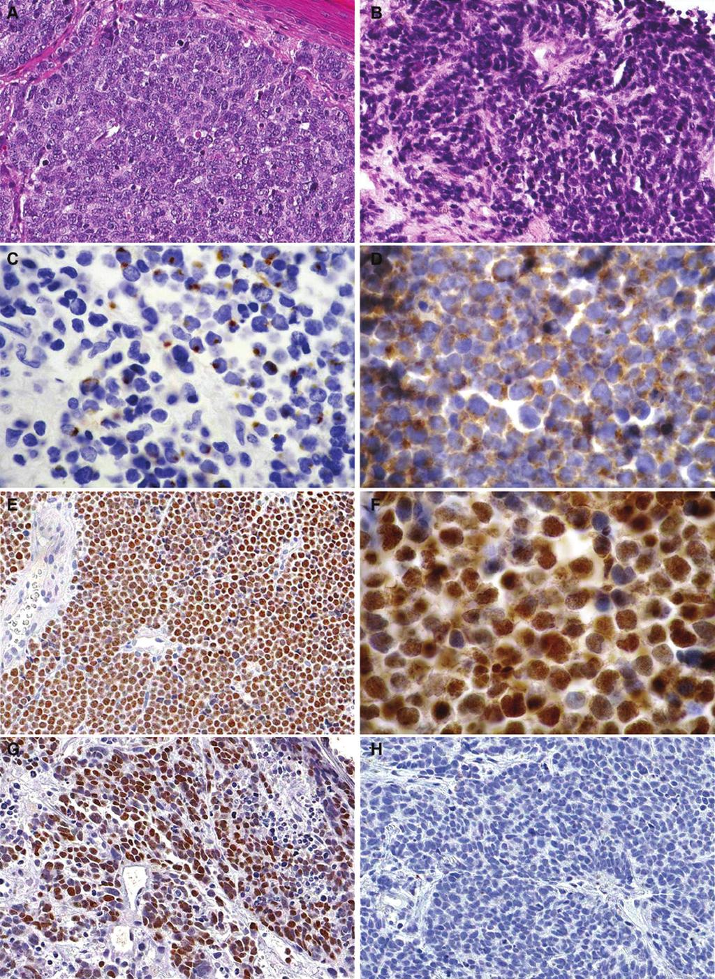 PAX5 and TdT expression in Merkel cell carcinoma Figure 1. A.