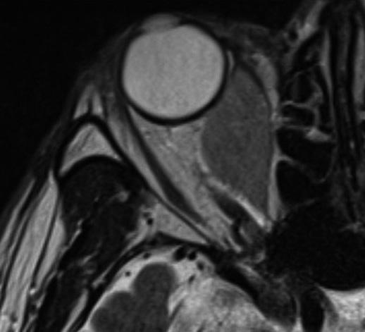 Contrast-enhanced axial CT image of the orbit shows a bulging mass