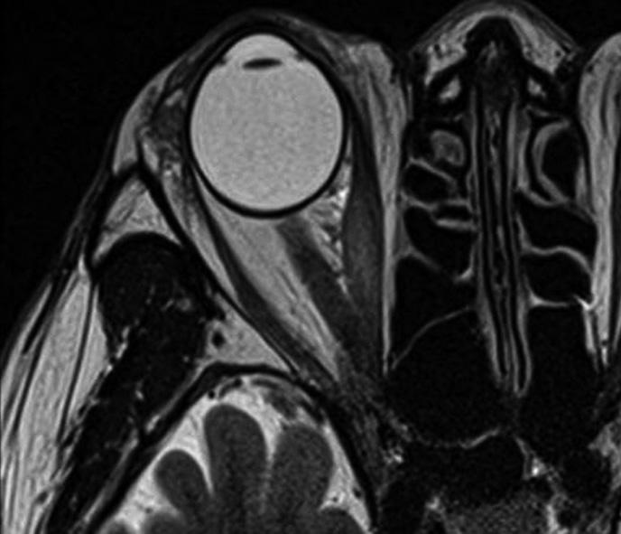 Gadolinium based contrast enhanced T1-weighted axial and coronal