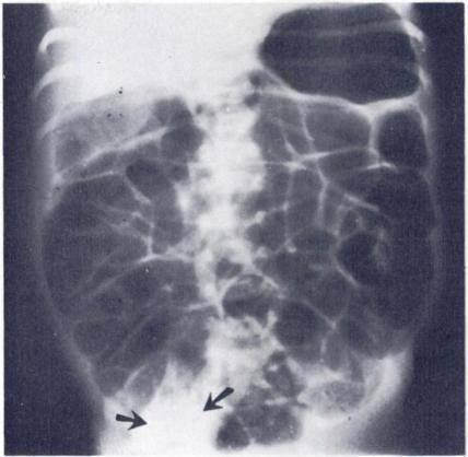 VOL. 120, No. 2 The Meconium Plug Syndrome 343 grams of the abdomen were obtained in 12 cases. No air-fluid levels were observed within the bowel in 7 of the 12 cases (Fig.