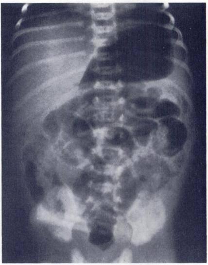 A collapsed or empty segment was noted distal to the meconium plug in 2 cases (Fig. 8). This pseudo transition simulated the appearance of Hirschsprung s disease.