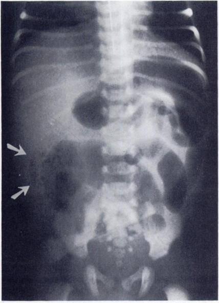 344 Rubem Pochaczevsky and John C. Leonidas FEBRUARY, 1974 FIG.. Case IV. Meconium plug syndrome. Four day old, premature, male twin with a history of sepsis and failure to pass meconium.