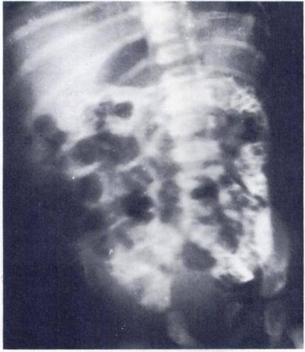 FIG.. Case VII. Meconium plug syndrome. One day old infant with abdominal distention and failure to pass meconium.
