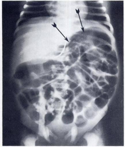 346 Rubem Pochaczevsky and John C. Leonidas FEBRUARY, 1974 TABLE II HIRSCHSPRUNG S DISEASE IN INFANTS FIG. io. Case xiv. Meconium plug syndrome.
