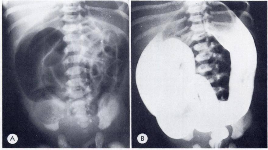 Note sausage shaped oblong density within distal lumen of transverse colon (arrows).