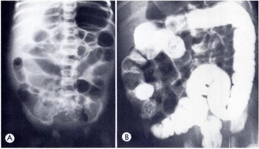 VOL. 120, No. 2 The Meconium Plug Syndrome 347 FIG. 12. Hirschsprung s disease. Two day old infant with a history of abdominil distention.
