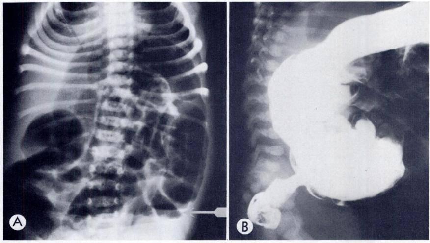 (B) Contrast enema study shows no evidence of transitional segments and no significant meconium. G.I3.Lirschsprung s disease.