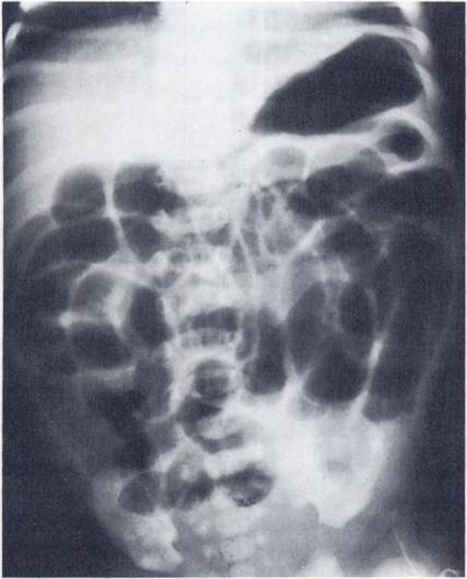 A barium enema study revealed a relative decrease in the caliber of the left colon. A diagnosis of Hirschsprung s disease was confirmed by rectal biopsy.