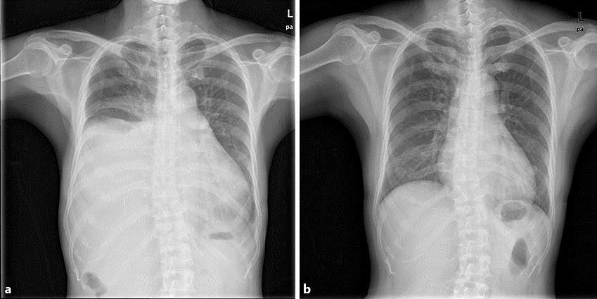 b Three months later, the chest radiography showed that the right hydrothorax had been completely absorbed. Fig. 2.