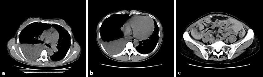 a The first CT scan showed right moderate pleural effusion, and the CT value of the right pleural effusion was 6 HU.