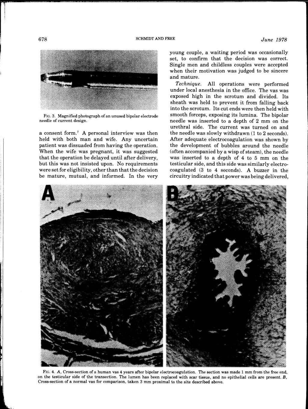678 SCHMIDT AND FREE June 1978 FIG. 3. Magnified photograph of an unused bipolar electrode needle of current design. a consent form. 7 A personal interview was then held with both man and wife.