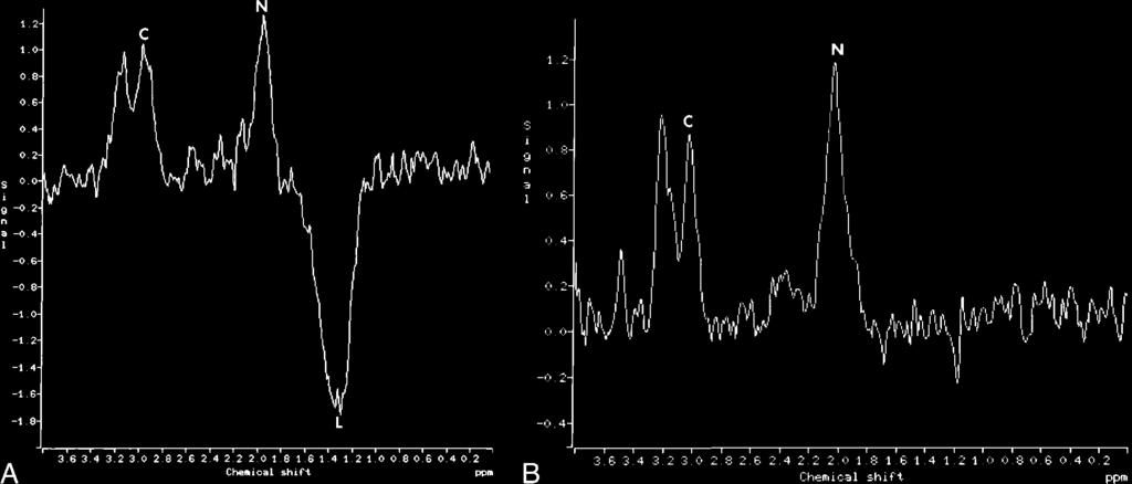 AJN: 22, January 2001 ACUTE TEMPOA OBE SEIZUES 153 FIG 1. Proton M spectroscopy in a patient with left hippocampal seizures and lactate.