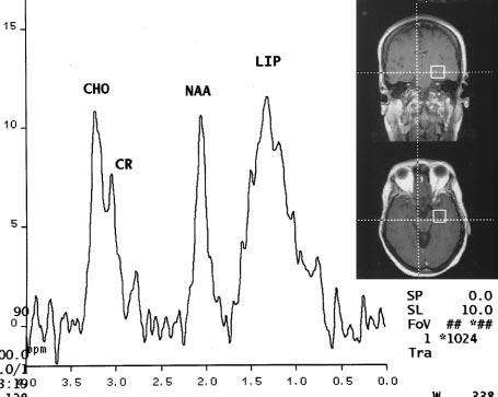 The NAA peak is normally lower in the hippocampi as compared with gray matter elsewhere. B, Single-voxel M spectrum of the right hippocampus shows no lactate. FIG 2.