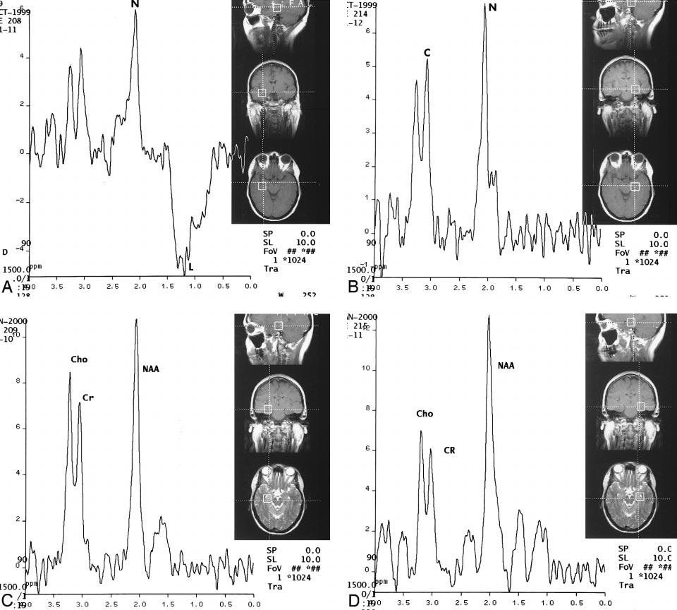 AJN: 22, January 2001 ACUTE TEMPOA OBE SEIZUES 155 FIG 3. Initial and follow-up proton M spectroscopy in a patient with left hippocampal seizures.